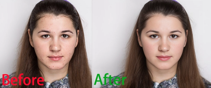 How to Remove Acnes from Photos