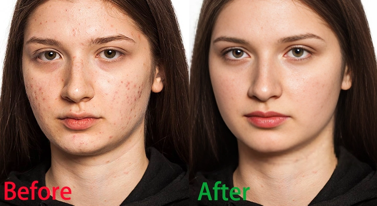 How to Remove Scars from Photos