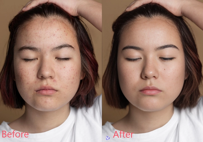 How to Smoothen Face Skin - Comparison